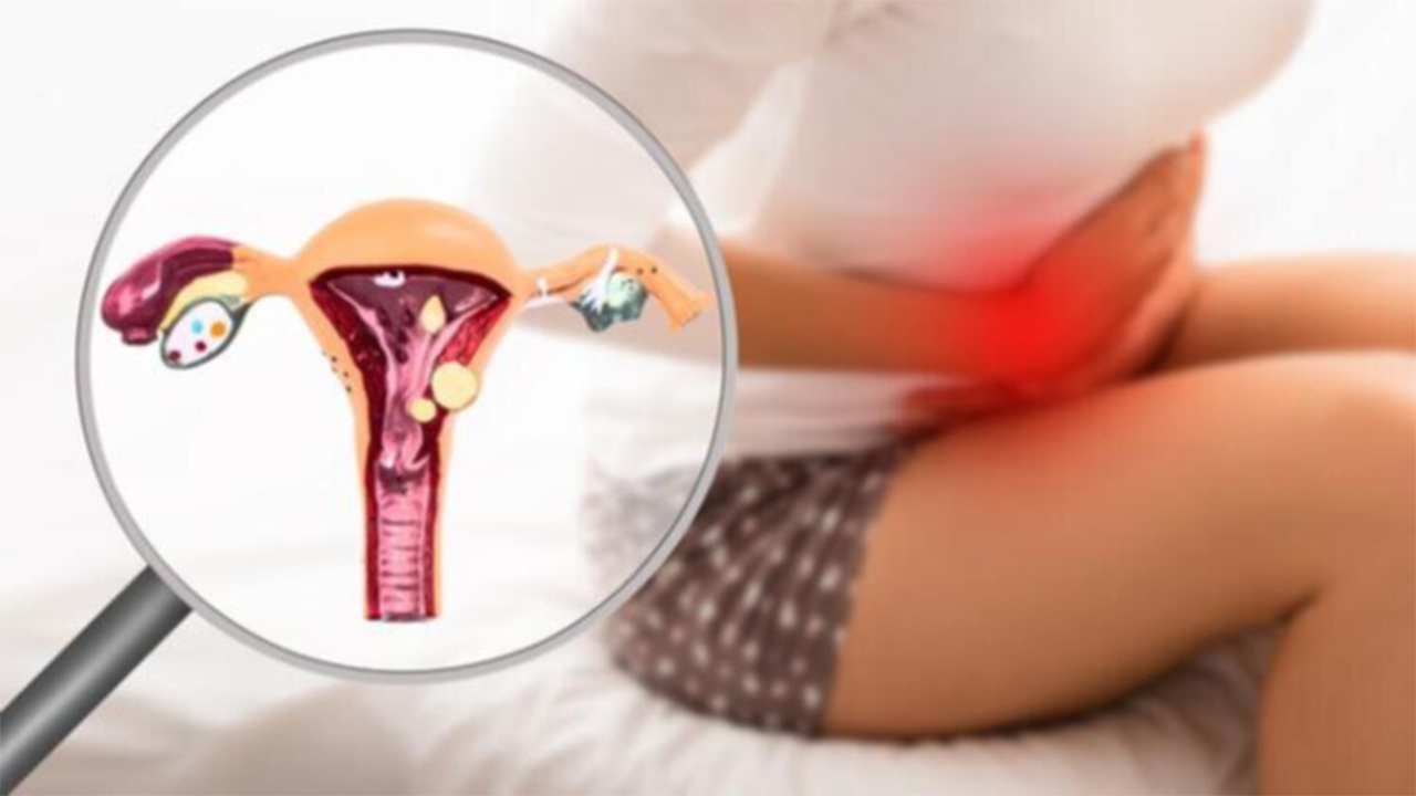 Endometriozis nedir? 7