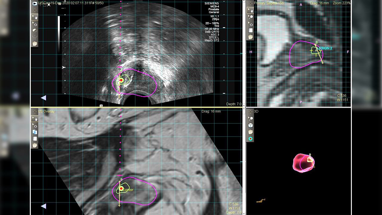 Özel Sağlık Hastanesi'nden 100'üncü MR Füzyon Biyopsisi 7