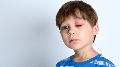 Dikkat! Her Şişlik ve Kızarıklık Alerji olmayabilir 1