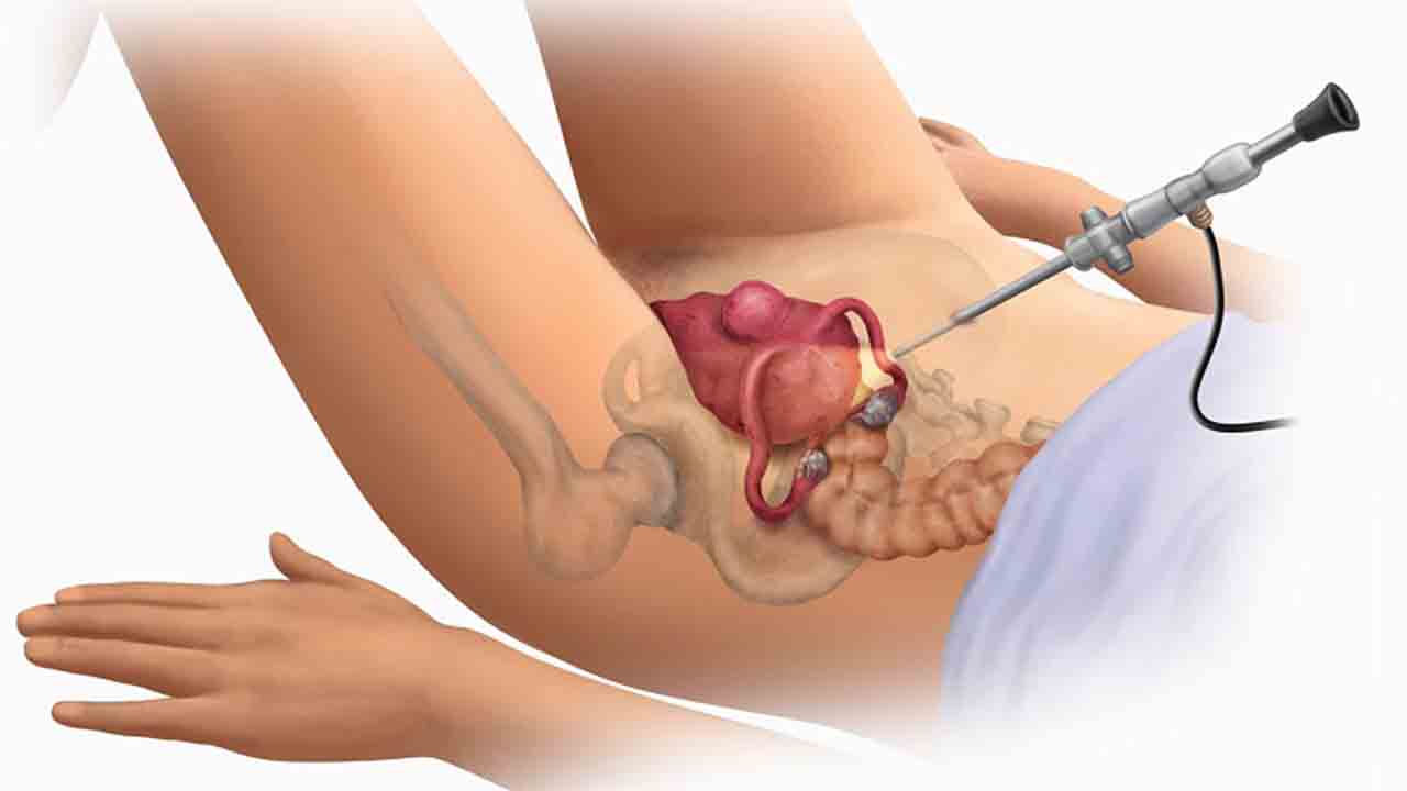 Miyom Kansere dönüşür mü? Nasıl anlarız? 7