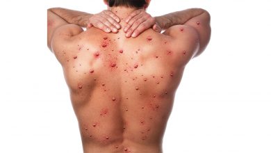 Maymun Çiçeği hastalığı nedir? 4