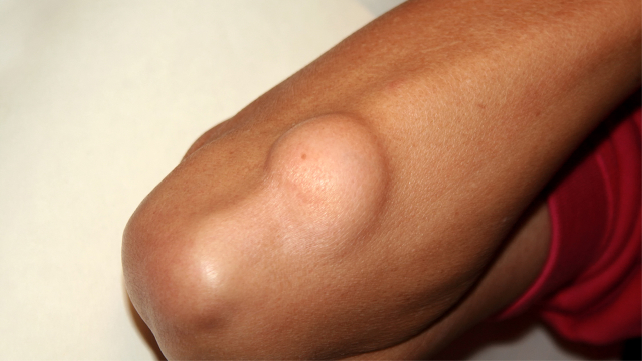 Yağ bezesi zannettiğiniz kötü huylu tümör çıkabilir! 7