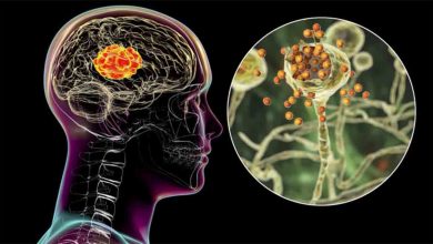 Beyin hastalıklarında dil ve konuşma nasıl etkilenir? 24