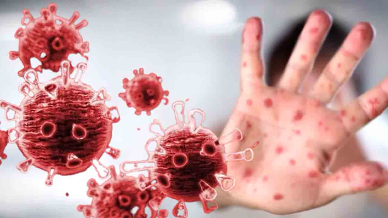 Türkiye'de 5 maymun çiçeği vakası tespit edildi 6