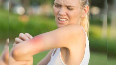 Arı sokmasına bağlı "Akut-alerji krizi" nedir? 1