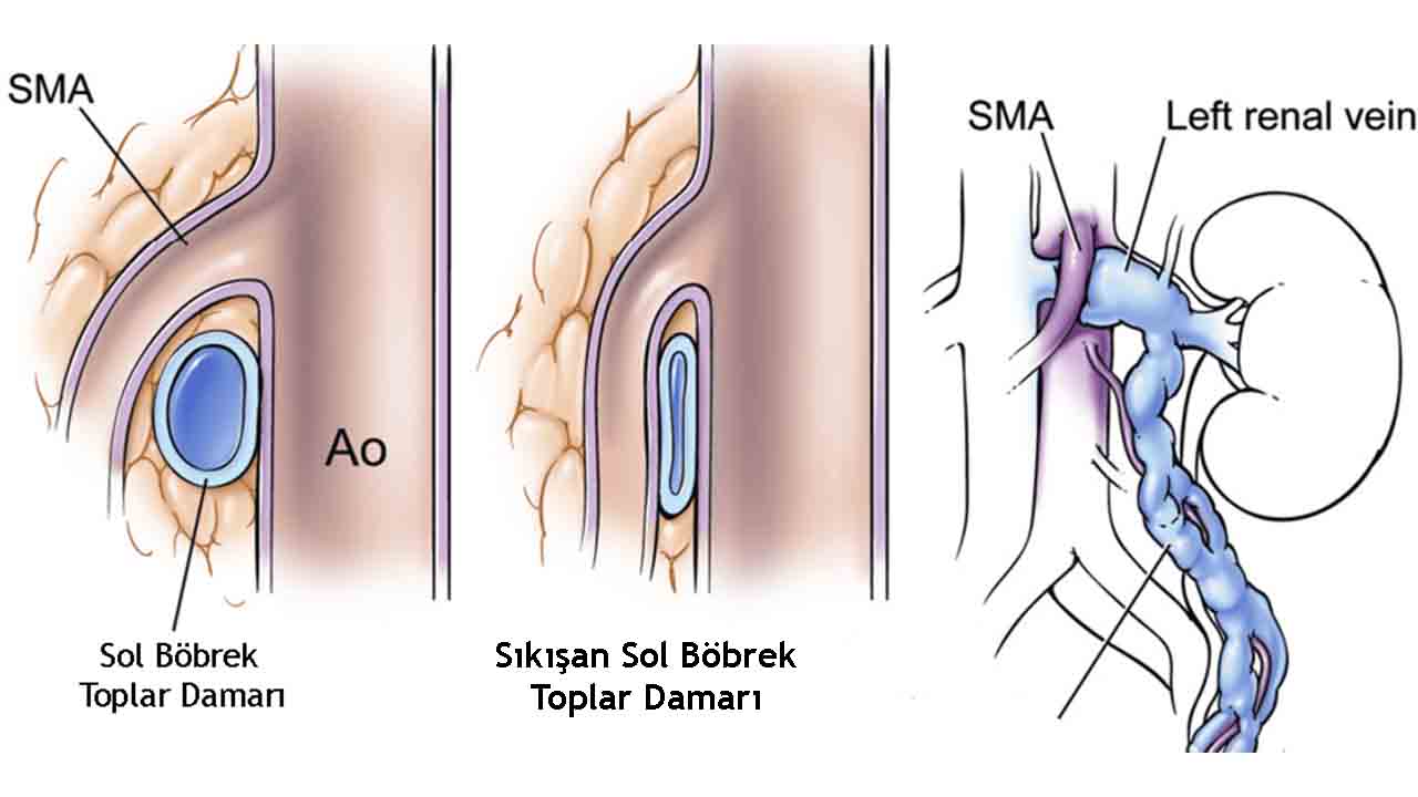Nutcracker Sendromu ( Fındıkkıran Sendromu ) Nedir? 6