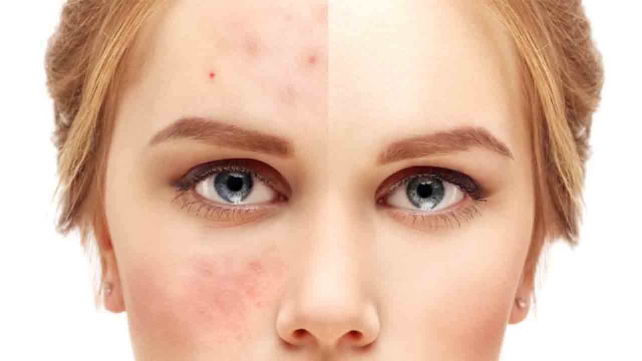 Akne ve Sivilcelerden nasıl kurtuluruz? 7