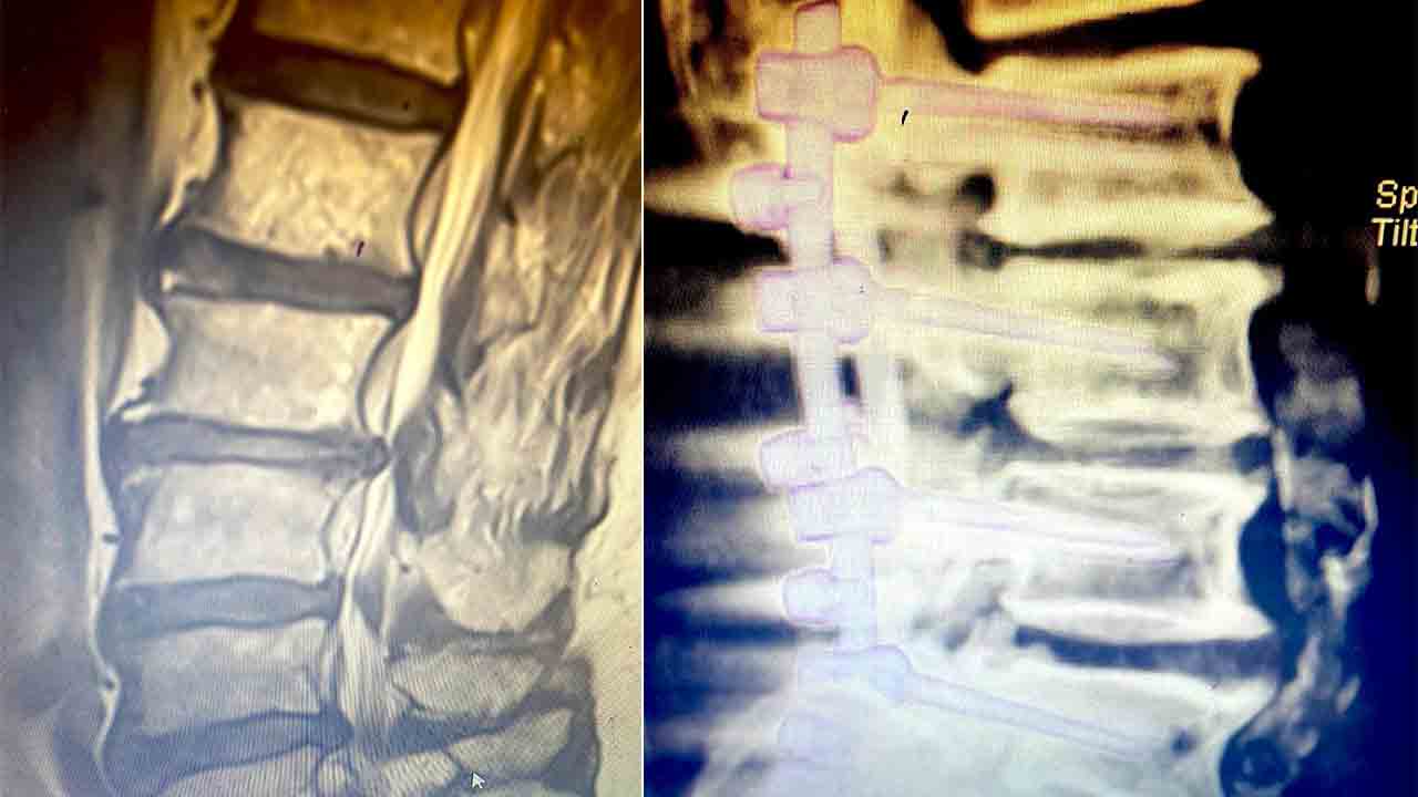 Belde Kanal Darlığı tedavisinde Erken teşhis önem taşıyor 7
