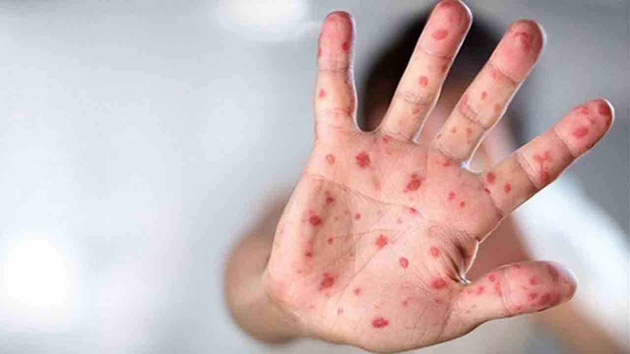 Türk bilim insanları Maymun Çiçeği için PCR tanı Kiti geliştirdi! 7