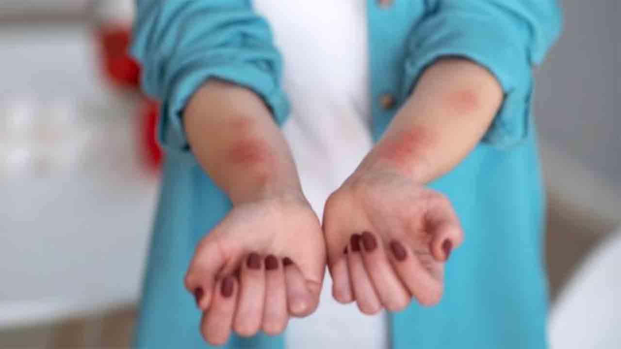 Ütopik Değil Ürtiker! 7