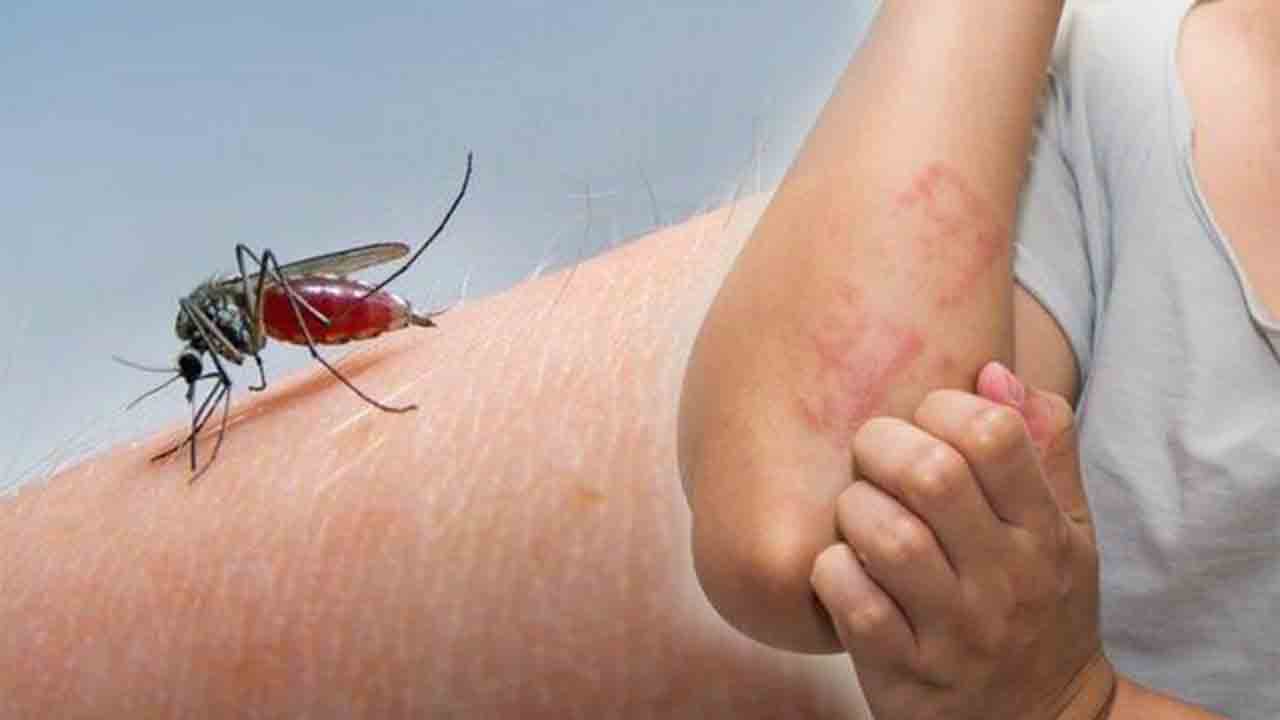 Sivrisinek ısırığına ne iyi gelir? 6