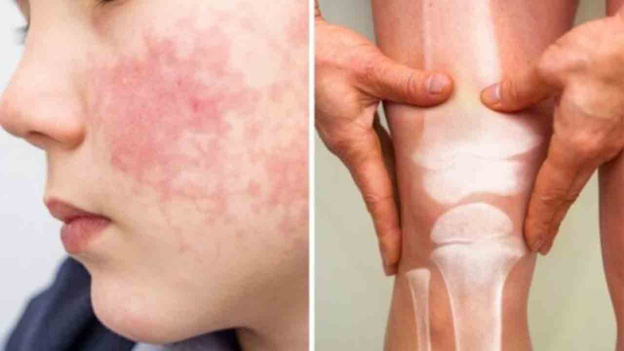 Yüzünüzdeki minik kelebekler bahar değil lupus belirtisi! 7