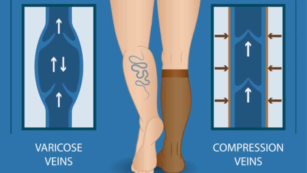 Kalp kapakçığı ile varisin ne ilgisi var demeyin! 7