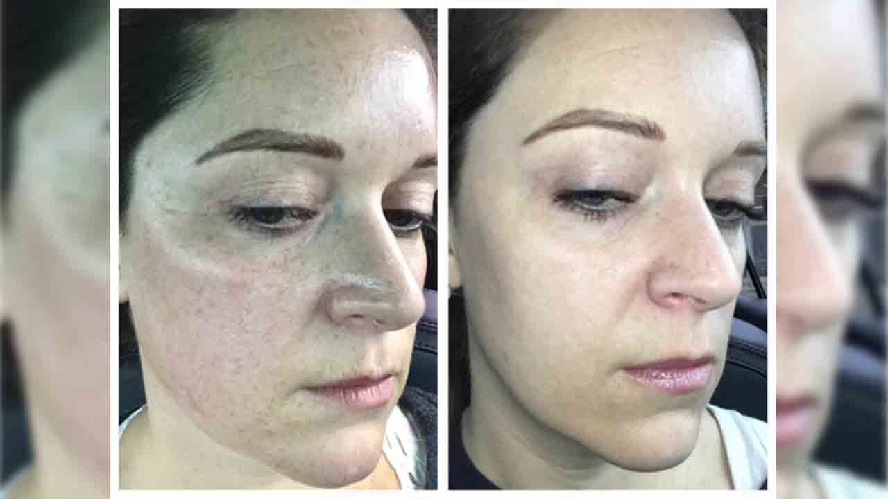 Sonbahara güneş lekeleri ile mi giriyorsunuz? 7