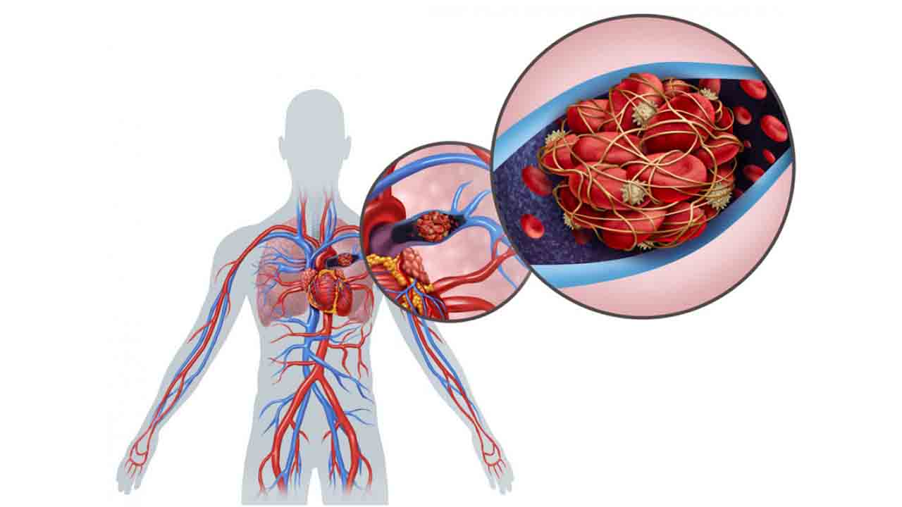 Dikkat! Akciğer embolisi riski taşıyor olabilirsiniz 7