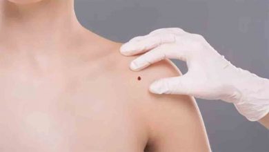 Vücutta Ben neden çıkar? Nelere dikkat edilmeli? 7