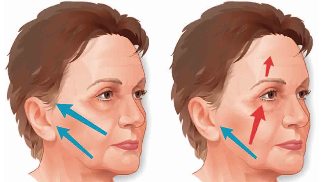 Estetik bağımlılığının olumsuz yansıması Overfılled Face Sendromu! 7