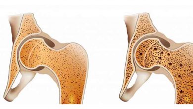 Kemik erimesi neden olur? Kemiklerimizi nasıl koruruz? 9