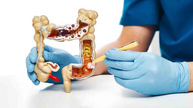 Kolon Kanseri nedir? Nelere dikkat edilmeli? 28