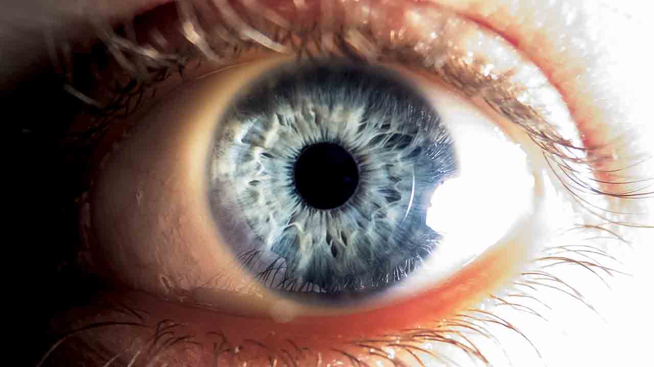 Femtosaniye Lazerle Katarakt ameliyatı 7