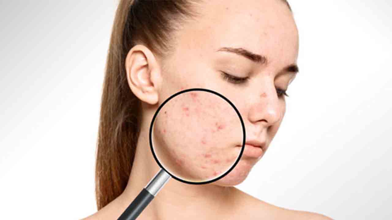 Akne problemi olanlar için önemli besinler ve tüketim önerileri 6
