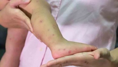 Kızamık Vakalarında Korkutan artış 1