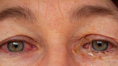 Gözde sulanma ve çapaklanmaya Dikkat ! 2