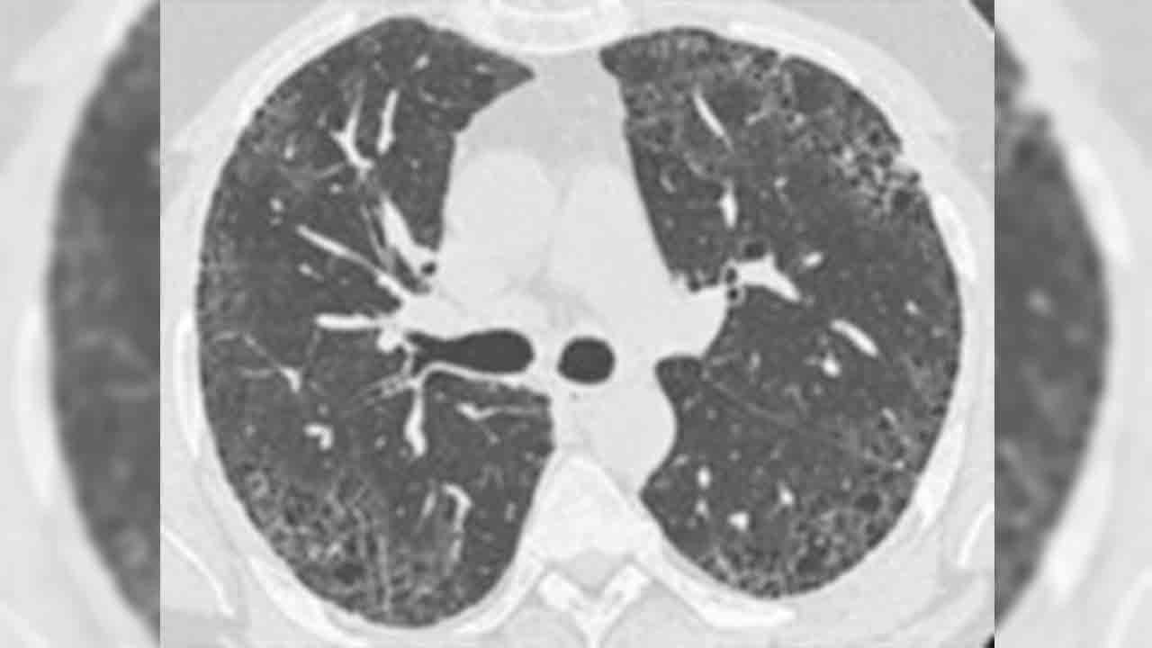 Tüsad’dan Pulmoner Fibrozis farkındalık Ayı’nda önemli uyarılar 7