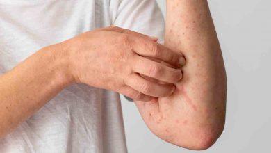 Gereksiz besin diyetleri ürtikeri tetikliyor! 1