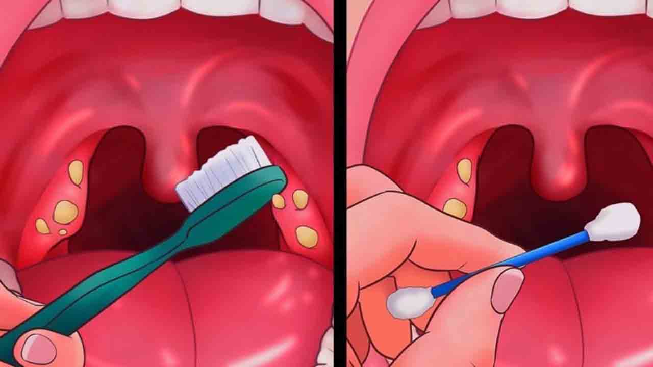 Bademcik taşı nedir? 6