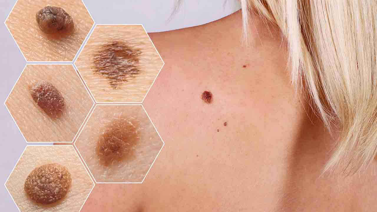 Cilt Kanseri Riskini Azaltmanın yolları 7