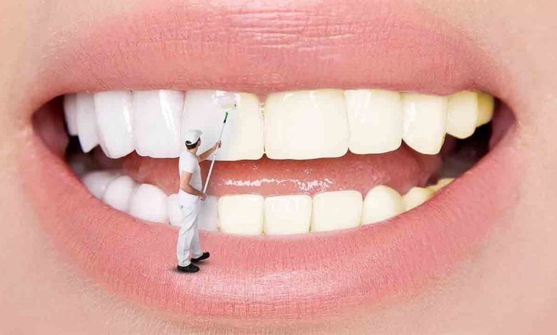 Diş beyazlatma işlemi diş hekimi tarafından yapılmalı 1