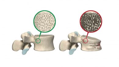Kemik Erimesi neden olur? Nelere dikkat etmeliyiz? Hangi yaşlar riskte? 1
