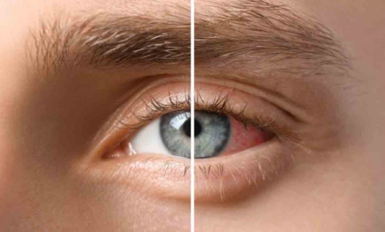 Kırmızı Göz tehlikesinin belirtileri ve Korunma yolları 1