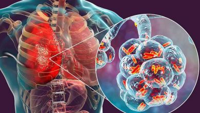 Lejyoner Hastalığı nedir? 1