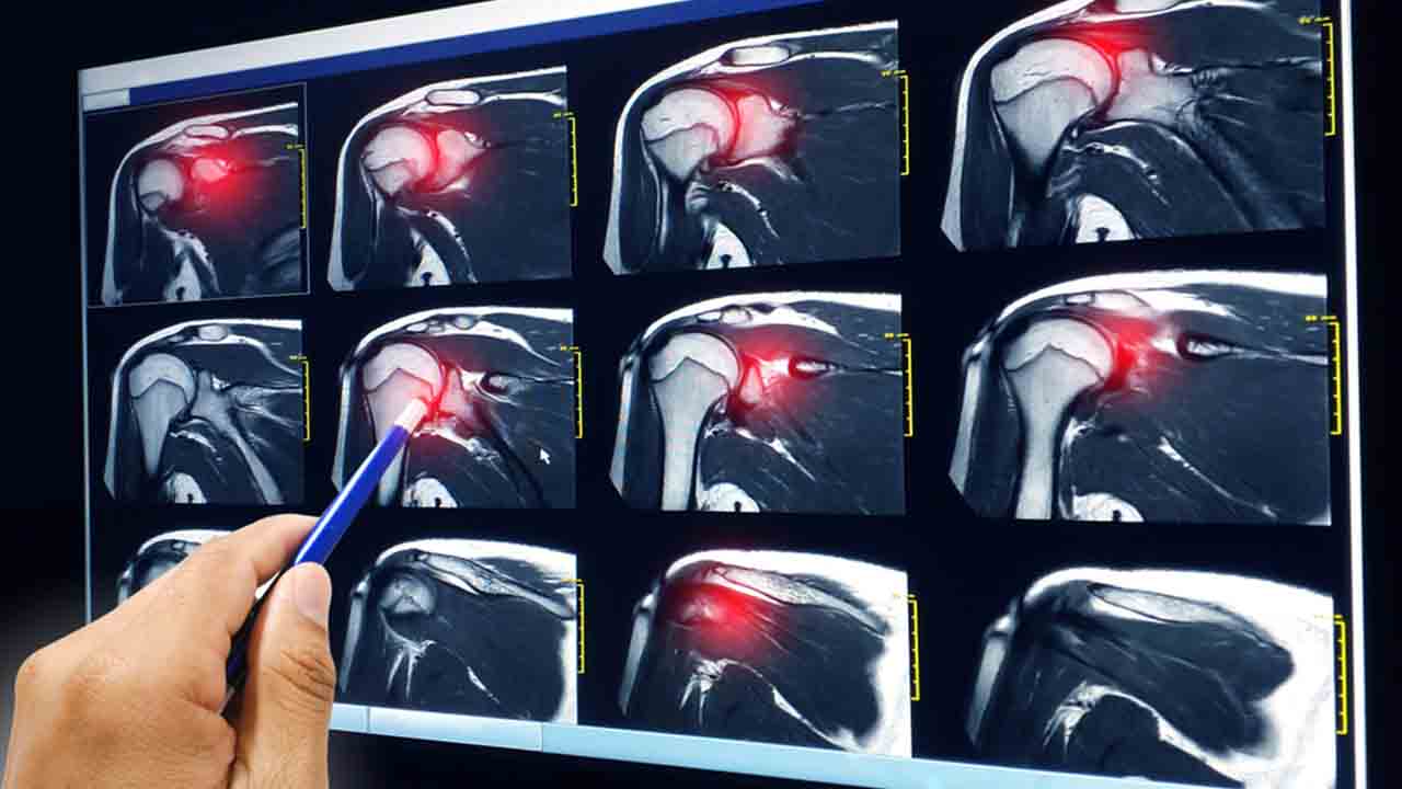 Omuz Yırtığı Ameliyatı 6