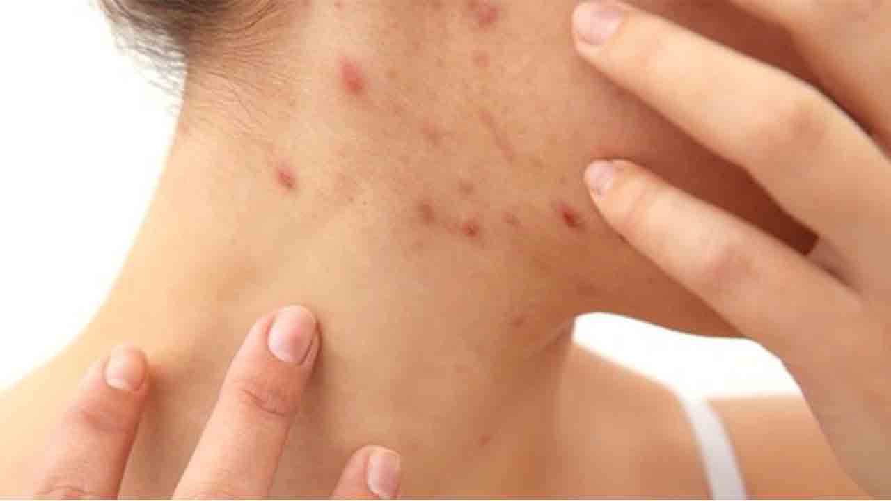 Soğuk havalar uyuz riskini artırıyor 6