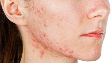 Yağ Bezesi nasıl geçer? 1