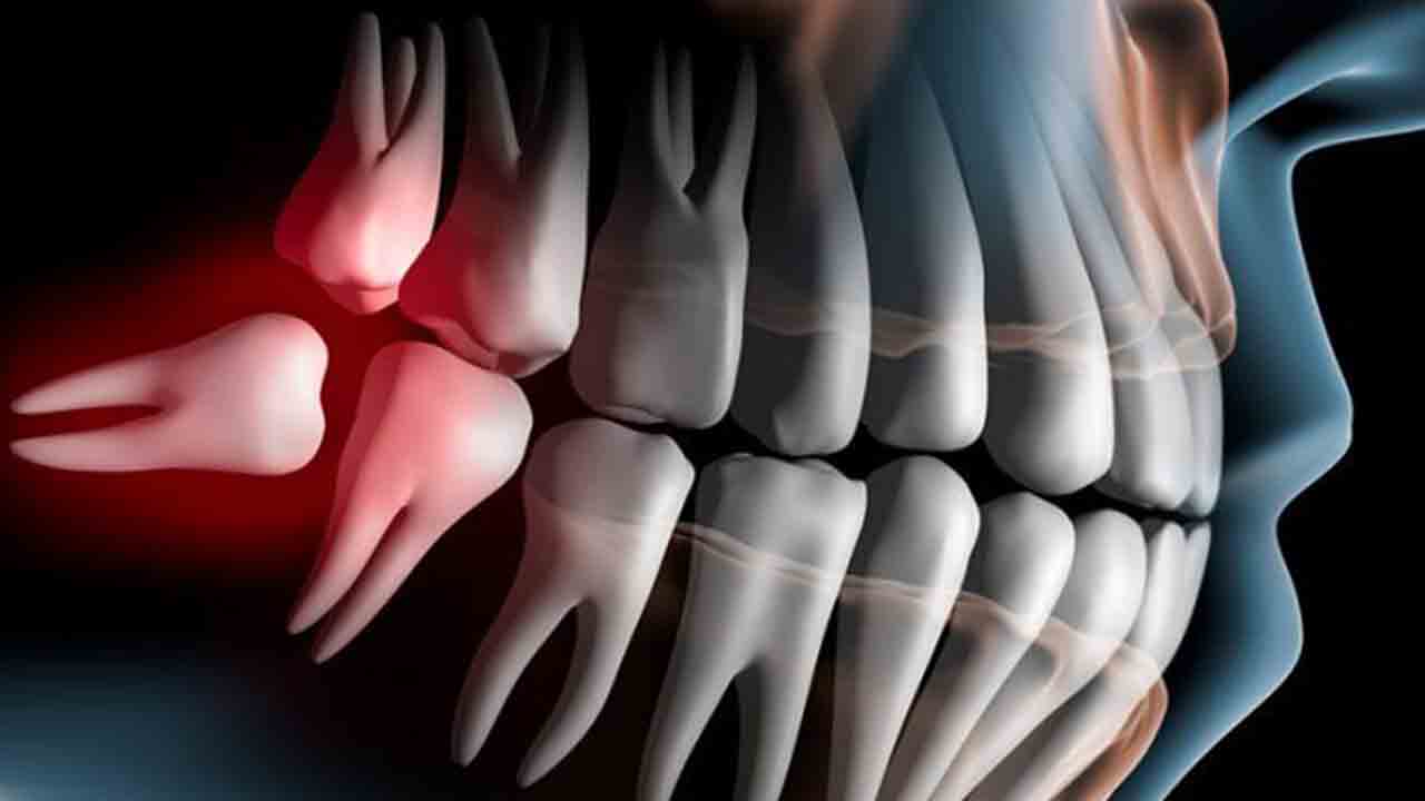 Перикоронарит воспаление. Ретинированный зуб мудрости. Дистопированный зуб мудрости. Зубы мудрости значение. Дистопированные зубы мудрости.