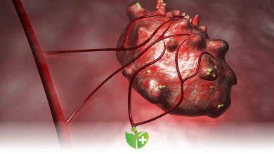 Dermoid Kistlerin çok bilinmeyen 3 belirtisi 4