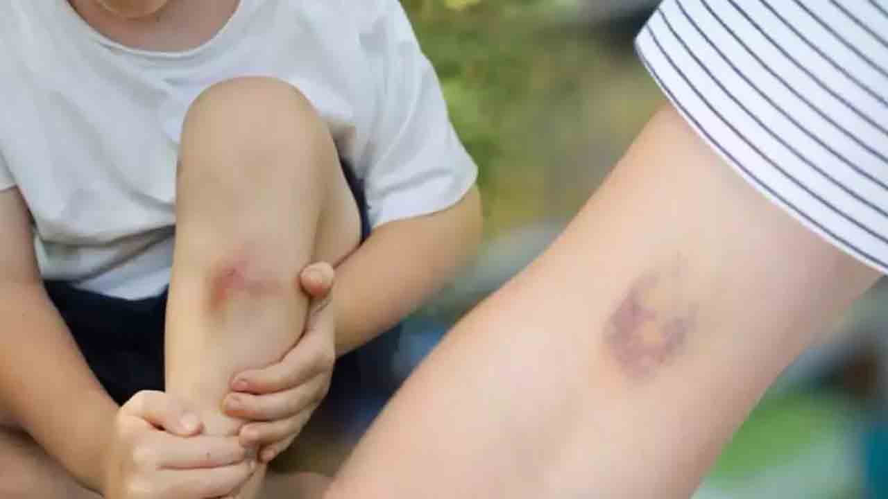 Çocuğunuzun Vücudundaki morlukları dikkate alın 7