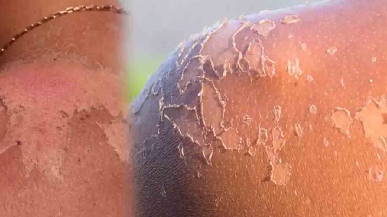 Neden derimizi soyariz? Nasıl engel oluruz? 7