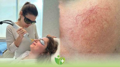 Kılcal Damar görüntüsü lazerle gideriliyor 1