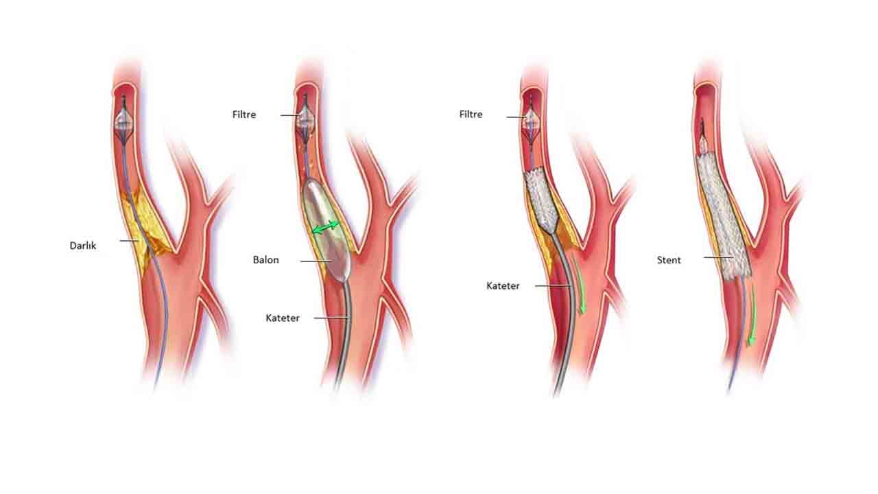 Şah Damarı (Karotis) tıkanıklığı belirtileri 6