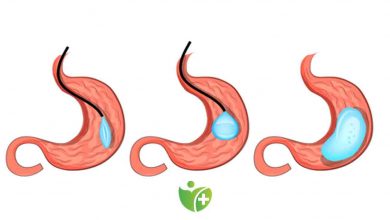 Obeziteye karşı ameliyatsız yöntem: Mide balonu 5