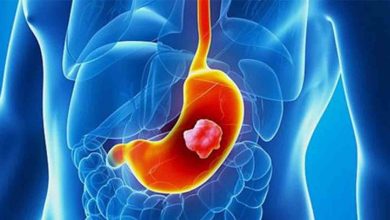 Mide kanaması nedir? Nasıl tedavi edilir? 3