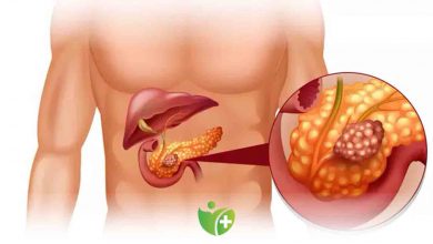 İshal Şişkinlik ve ani kilo kaybı Pankreasınız için alarm belirtisi olabilir 1