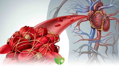 Pıhtı Atması nedir? Kimler de görülür? 1