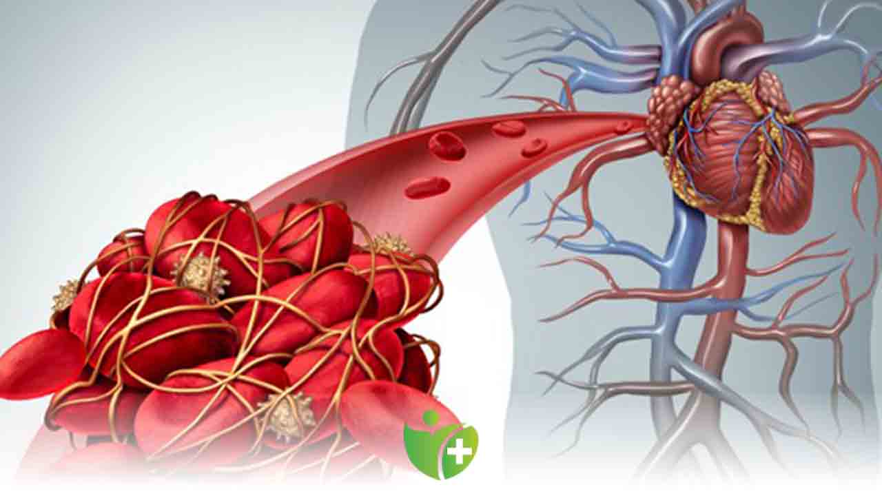 Pıhtı Atması nedir? Kimler de görülür? 7