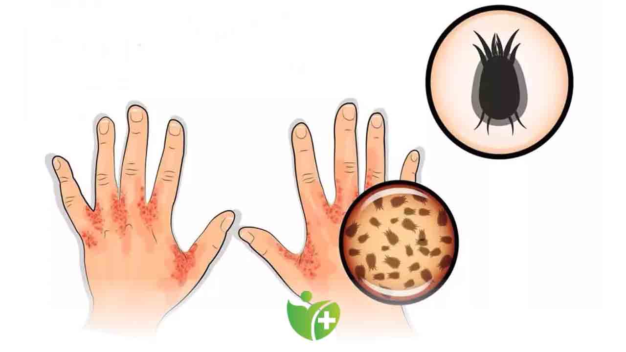 Uyuz, cinsel partnere ve ev halkına daha kolay bulaşıyor 7